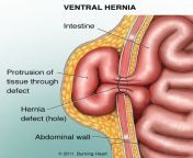 ventral hernia.jpg from hiania