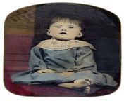 child.jpg from postmortem in a dead body