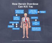 how heroin overdose can kill you.png from welcome back ki heroin ka