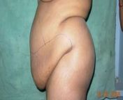 liposuction 500x500.jpg from indian aunty back side hole fucking
