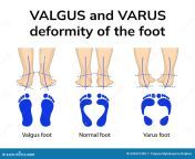 varus e deformidade valgus do pé ilustração da posição dos pés em deformidades representado é uma vista à retaguarda 243241309.jpg from pratima valgos