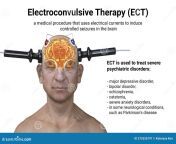 electroconvulsive therapy ect treatment involving use electrical currents to stimulate brain d illustration used 275326797.jpg from ekt 5ymypuo