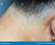 fechado de tinea ringworm na cabeça do homem asiático encerrado pela tineia dermatite 149409486.jpg from tineia