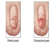 8d5e90e6dd334ba4180d39a02b3a13db circumcision img1.jpg from penis circum