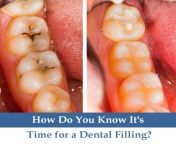 dental filling 1.jpg from filling