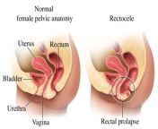 rectocele 1 e1450001727312.jpg from prolapses her cervix during anal sex 03012 prolapses her cervix during anal sex