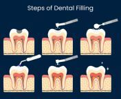 steps of dental filling.jpg from filling