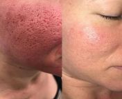 enlarged pores1.jpg from red pore