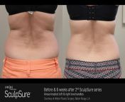 sculpsure before after.jpg from sculpsure microsite 0022 jpg