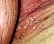 health yeast infection 161 canpust 2dc44fa1369a452899d6f3811da15084.jpg from pusyeasty