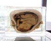 dead fetus in womb preserved forensic medicine museum siriraj hospital bangkok thailand 2633477028.jpg from dead body xxx postmortem video porn in lusaka zambia com bangla sex