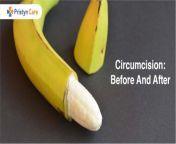 circumcision before and after.jpg from penis circum