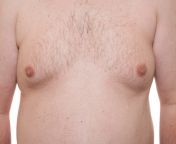 تضخم الثدي عند الرجال 670x420.jpg from ظهور الاثداء