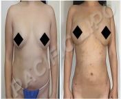 breast augmentation 1 .jpg from navel augmentation