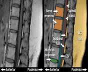 mri spine normal t1 jpgmtime20210304211353focalnone from t1 img