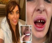 teeth comp jpgw620 from turkish dentist scandal