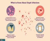 staph infections 3156887 final2 48c3a7caea8f429a94f7d074e66d5842.png from sitaph