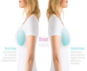 breast implants.jpg from breast implant