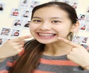 img 7171 773x1024.jpg from braces pinay