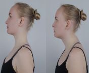 6273c22fb722c42a1795a797 symptoms of neck hump by cult fit.jpg from hump by