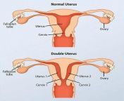 46991523 10807237 a graphic compares what a normal uterus looks like compared to a a 1 1652368620068.jpg from women with two vaginas