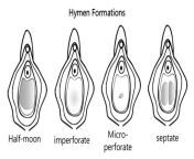 hymen formations 1024x580 jpgresize1024580 from virgin pussy deformation