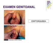 examen fsico genitoanal 5 320.jpg from semiologia pediatrica genital