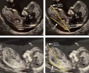 examples of nub theory on 12 week ultrasound scan ea1500f jpgquality90resize980654 from 14 sex 15