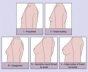 puberty breasst 300x234.jpg from budding breast