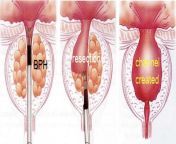 transurethral resection of the prostate urology toowoomba dr nikhil sapre.jpg from tudp