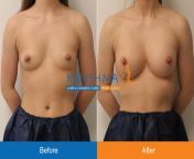 breast implant 4.jpg from kinnar boobs