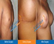 breast implant 3.jpg from kinnar boobs