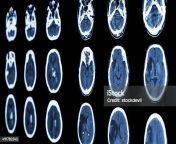 ct scan of brain show ischemic stroke and hemorrhagic strok jpgs612x612wisk20cuxxy2hz iy00jc3m2bgllpbiopj ihqnk xszkk7opy from india blue filmct