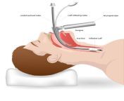 intubation for a patient with respiratory arrest or difficulty in breathing jpgs612x612w0k20chsndut 6v4xpuh2rsfvzjs2y87ojjzvmeuq1sehvsgy from intubated jpg