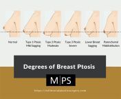 degrees of breast ptosis.jpg from perky boobs