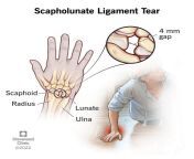 24558 scapholunate ligament tear.jpg from è°·æ­è½¯ææ¥åãtcp4 comãå¤§èµ¢å®¶å®æç24558