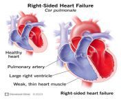 24922 right sided heart failure from hart cor