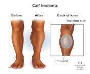 23253 calf implants from calf