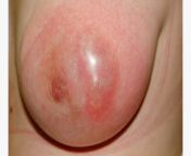 subareolar breast abscess 1296x728 slide1.jpg from milk boob pus
