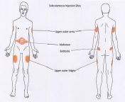 subcutaneous injection sites 002.jpg from injection roughman
