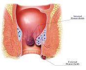 hemorrhoid diagram 500.jpg from real anal pain style