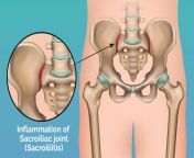 so inflammation of sacroiliac joint sacroiliitis 1.jpg from sileeping si