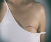 breast cancer surgery scar istock jpgve1tl1ve1tl1 from de mama mastectomia breast cancer mastectomy