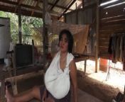 payudara terus tumbuh tak terkendali wanita ini kesakitan bog thumb.jpg from tetek besar cambodia