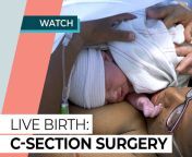 csection live birth thumbnail 3 4x3.jpg from doctor pregnancy sex delivery vid