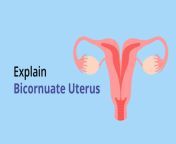 explain bicornuate uterus.jpg from জরায়ু তে বীর্য যাওয়া ভিডিও