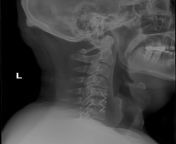 cervical center common diagnosis 5.png from acdr