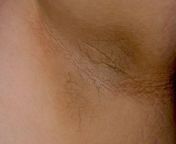 dark underarms which is also known as acanthosis nigricans br image credit madhero88 2010 br.jpg from undrams image