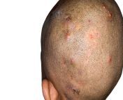 numerous painful furuncles or boils and folliculitis on head jpgv1625819832 from head pus