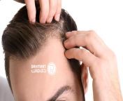 home treatment hair loss dandruff.jpg from سر